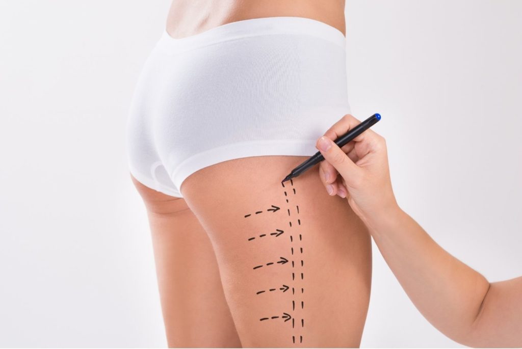 Back Liposuction Orlando - Orlando Liposuction Specialty Clinic